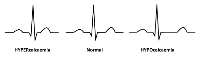 Hypercalcemia