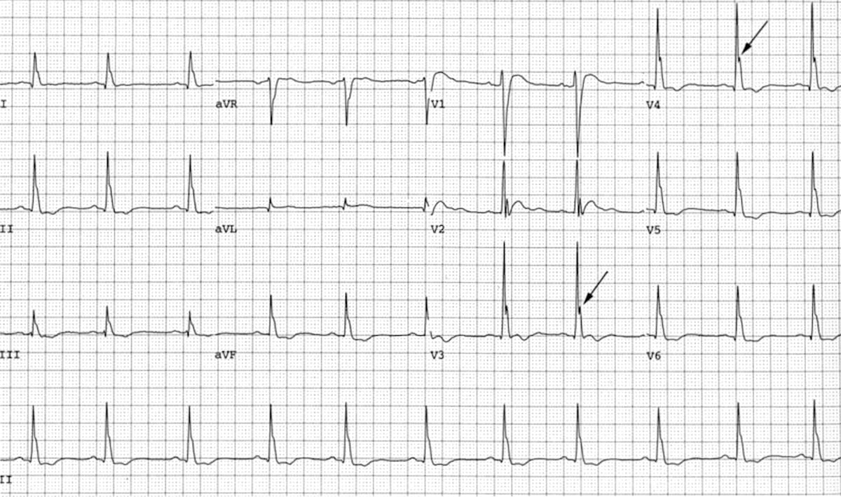 Hypercalcemia