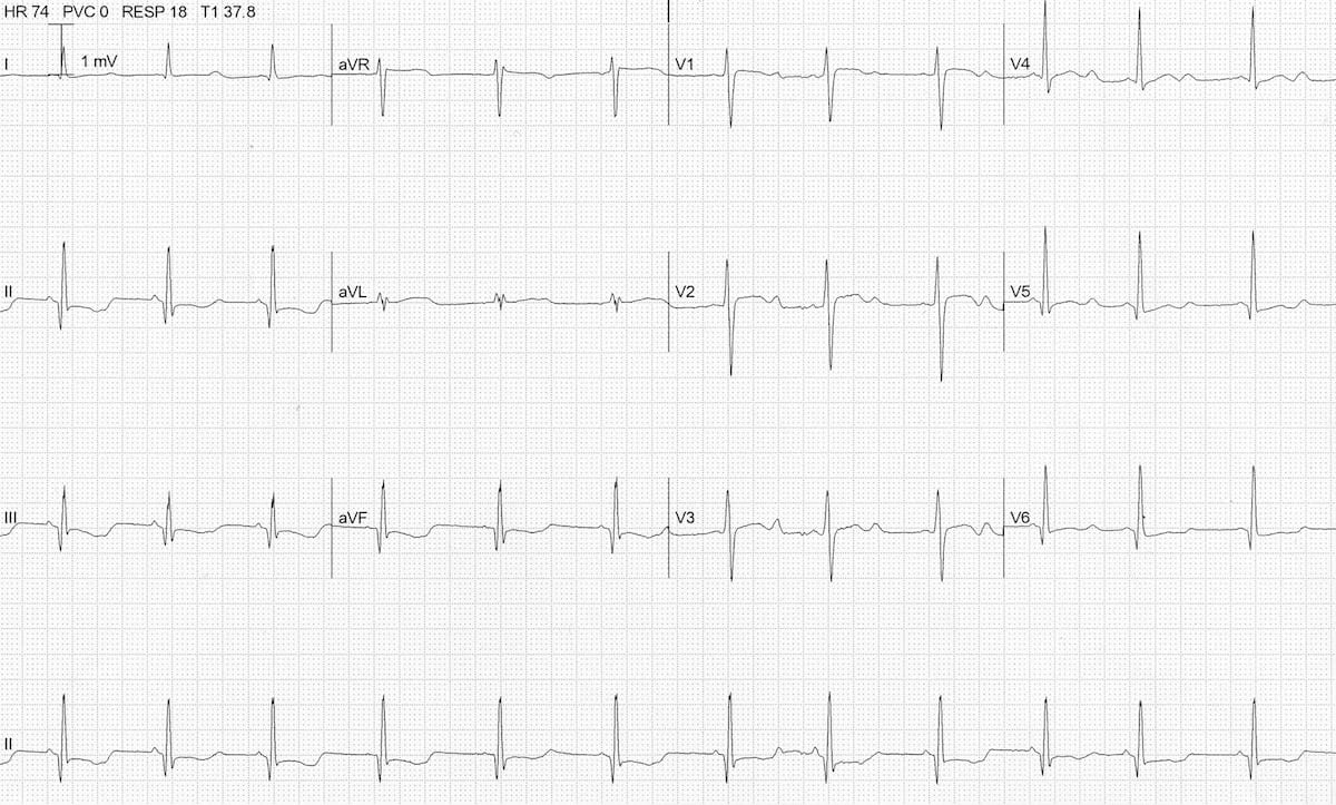 Hypokalaemia