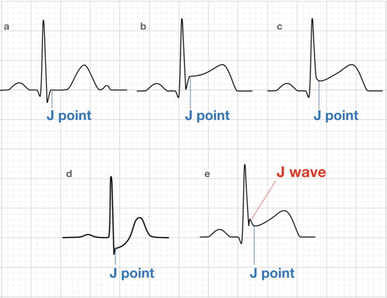 J point