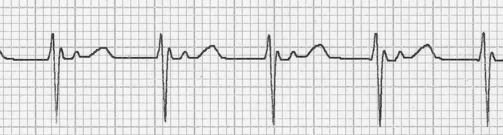 Junctional escape rhythm
