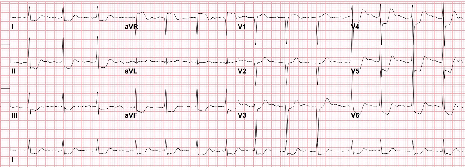 Left main occlusion - Myocardial Infarction