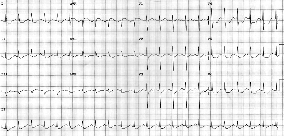 Myocardial Infarction