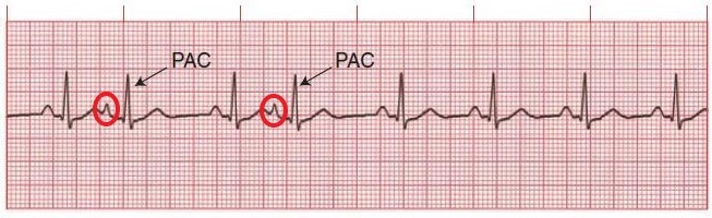 Premature atrial contraction (PAC)