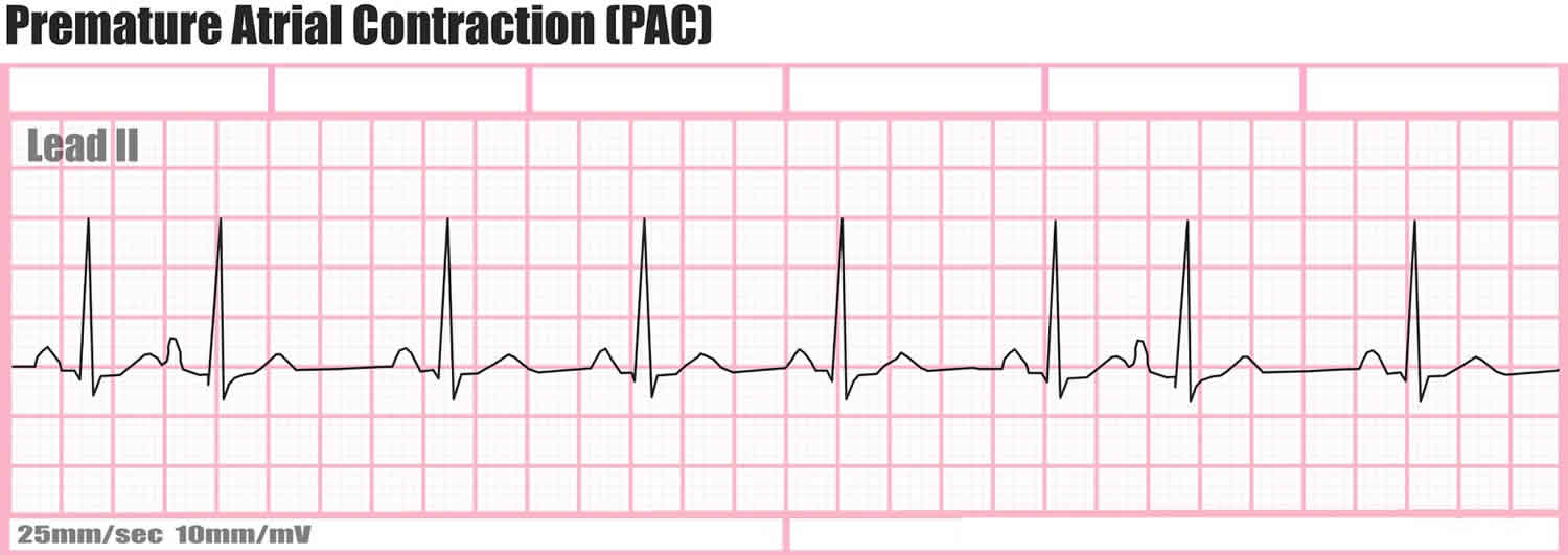 Premature atrial contraction (PAC)