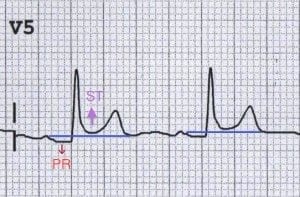 Pericarditis