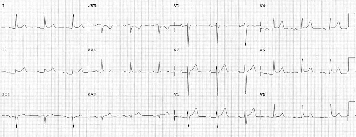 Pericarditis