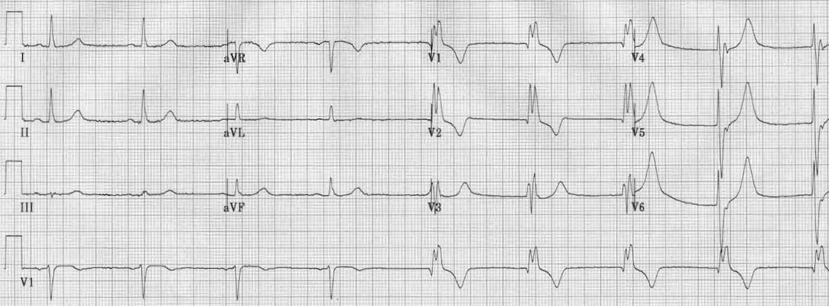 Right Bundle Branch Blocks