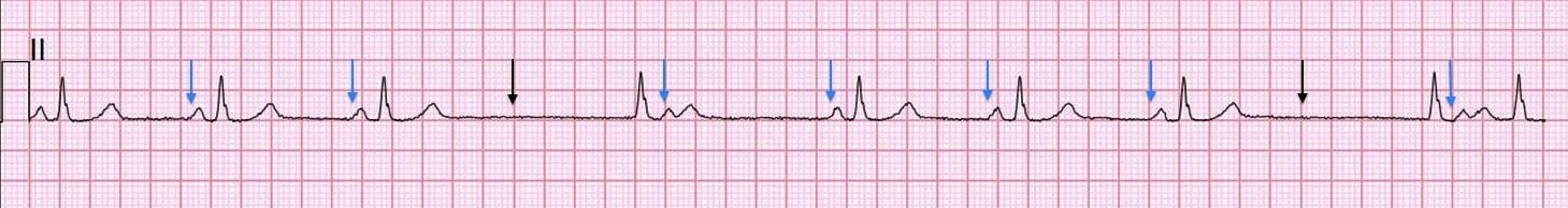 Sinus arrests and SA Exit Blocks