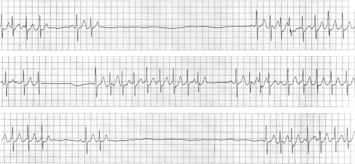Sinus arrests and SA Exit Blocks